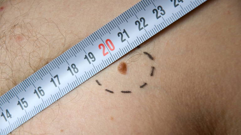 Desarrollan un modelo de inteligencia artificial que previene la metástasis de uno de los cánceres más comunes